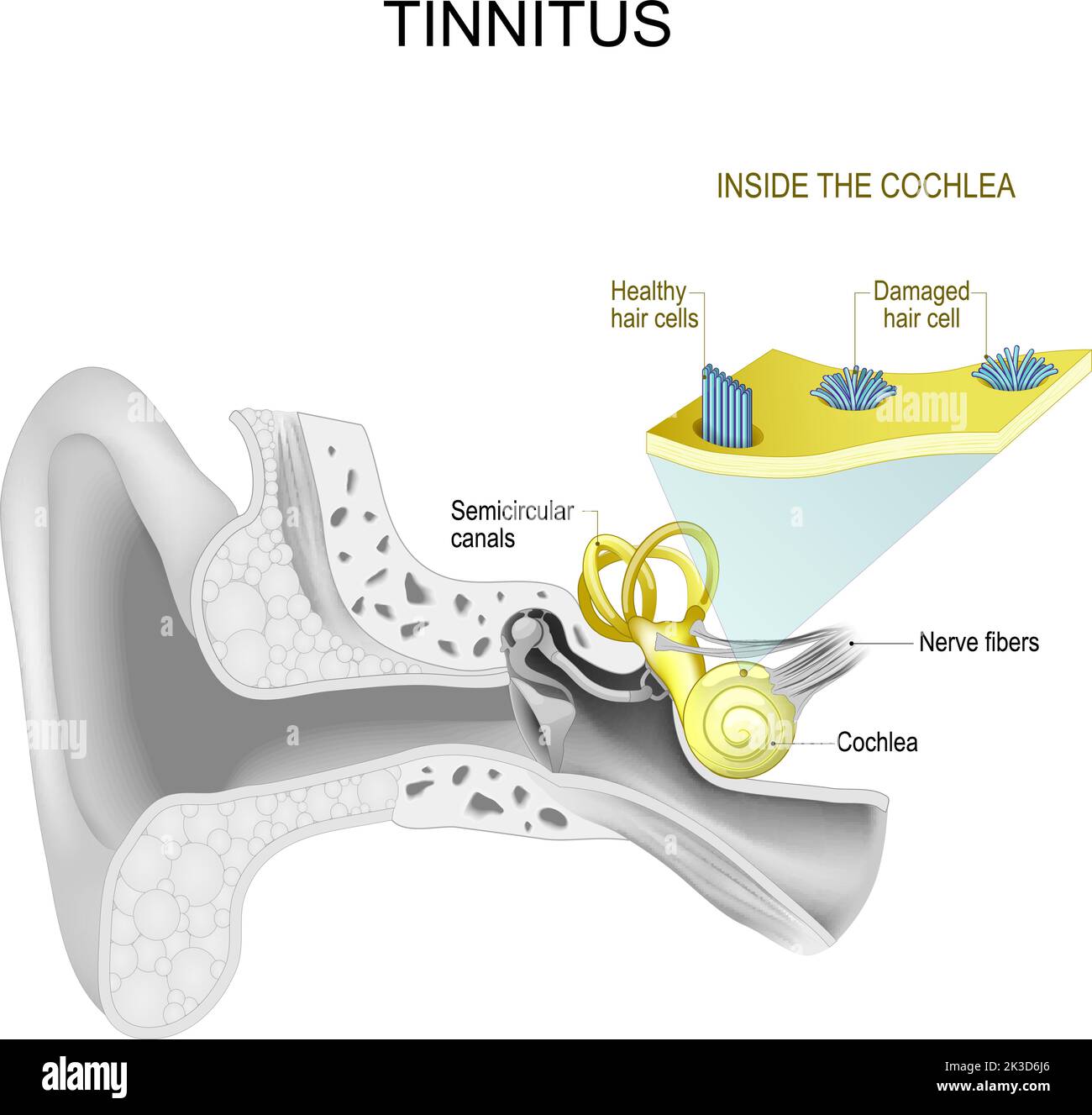 Tinnito. Orecchio umano. Parte del sistema uditivo. All'interno della coclea. Primo piano del sistema di cellule dei capelli sane e danneggiate. Illustrazione vettoriale. Illustrazione Vettoriale