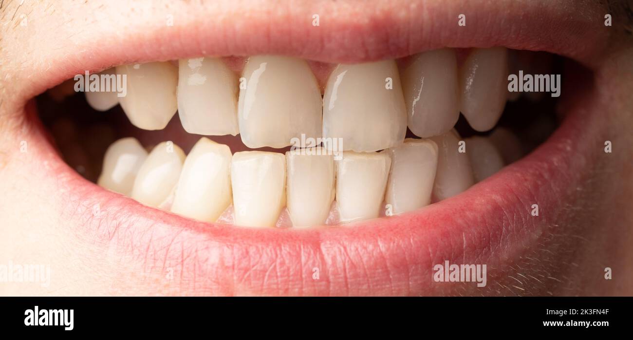 Denti umani bianchi puliti con una vista ravvicinata a forma di sorriso Foto Stock
