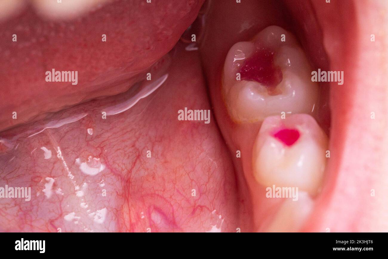 Bocca del bambino con otturazioni dentali multicolore dopo trattamento dentale in odontoiatria pediatrica. Tecnologia moderna per i bambini. Foto Stock