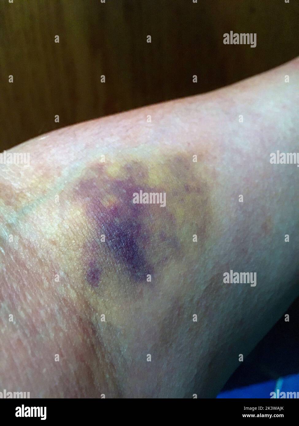 Blauer Fleck , Hämatom am Arm nach Blutentnahme Foto Stock