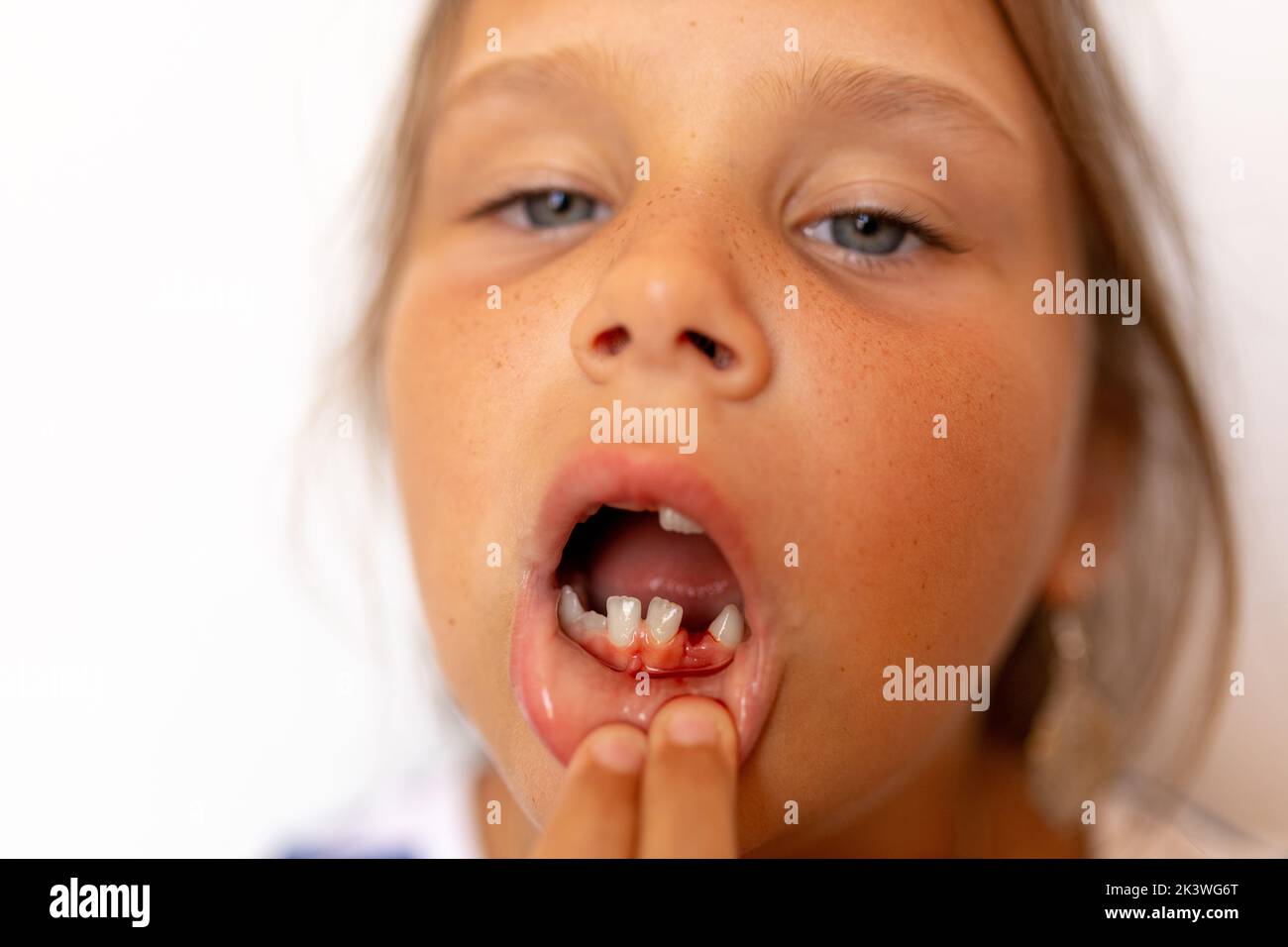 Ragazza piccola triste e stanca tira fuori il labbro per mostrare la bocca senza denti, fresco sanguinamento della ferita dopo l'estrazione del dente. Trattamento dentista Foto Stock