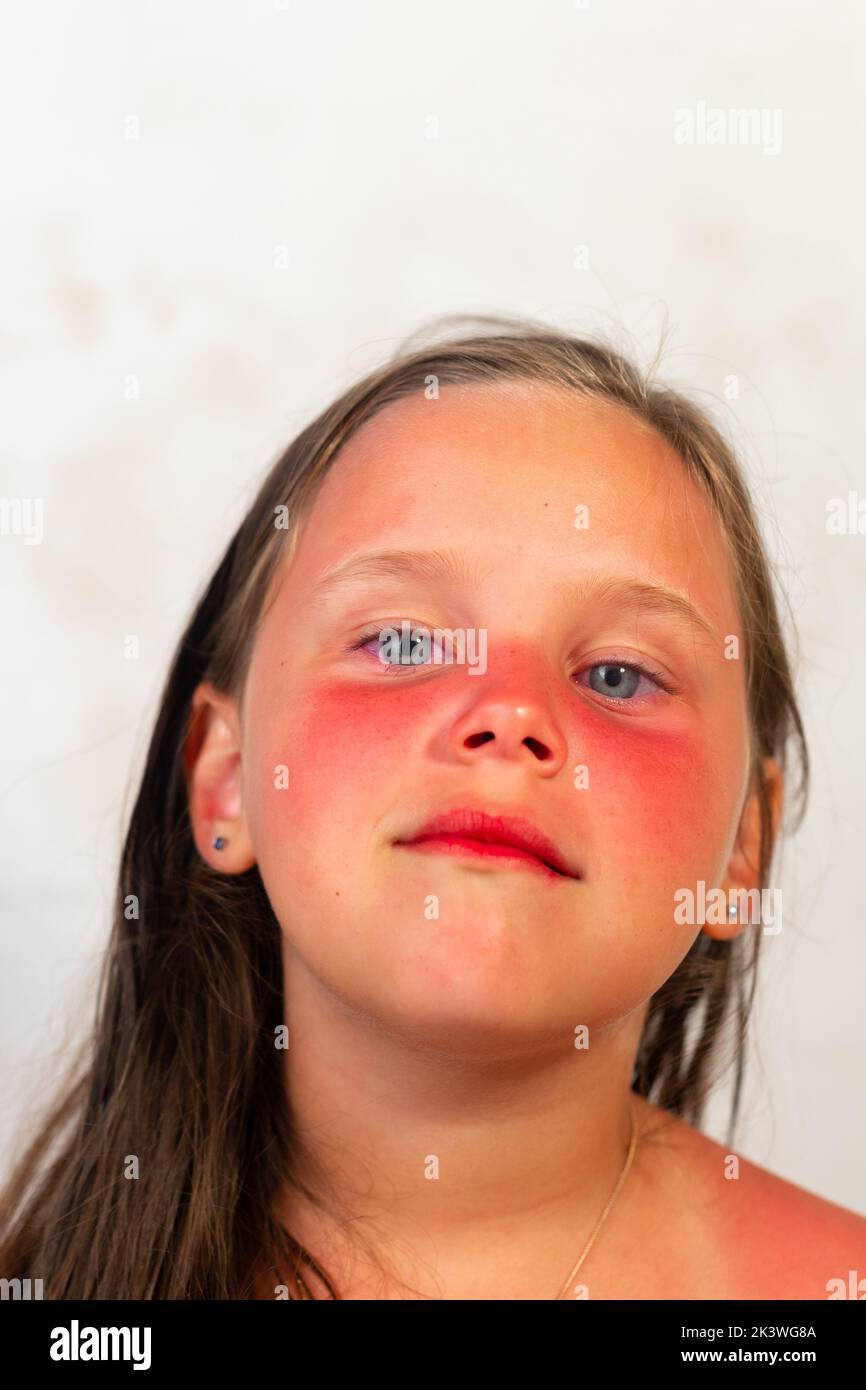 Primo piano ritratto di bambina con gravi ustioni rosse su naso e guance dopo aver trascorso il tempo al sole, sfondo grigio. Bambino con aree infiammate di Foto Stock