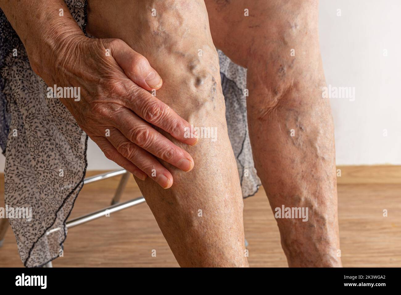 Mano donna anziana mostra le gambe nude con infiammazione delle vene varicose. Tromboflebite, problema di embolia. Bisogno di chirurgia laser Foto Stock