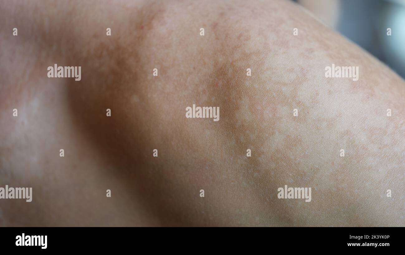 Problemi di cura della pelle macchie sulla pelle spalla e concetto di salute Foto Stock