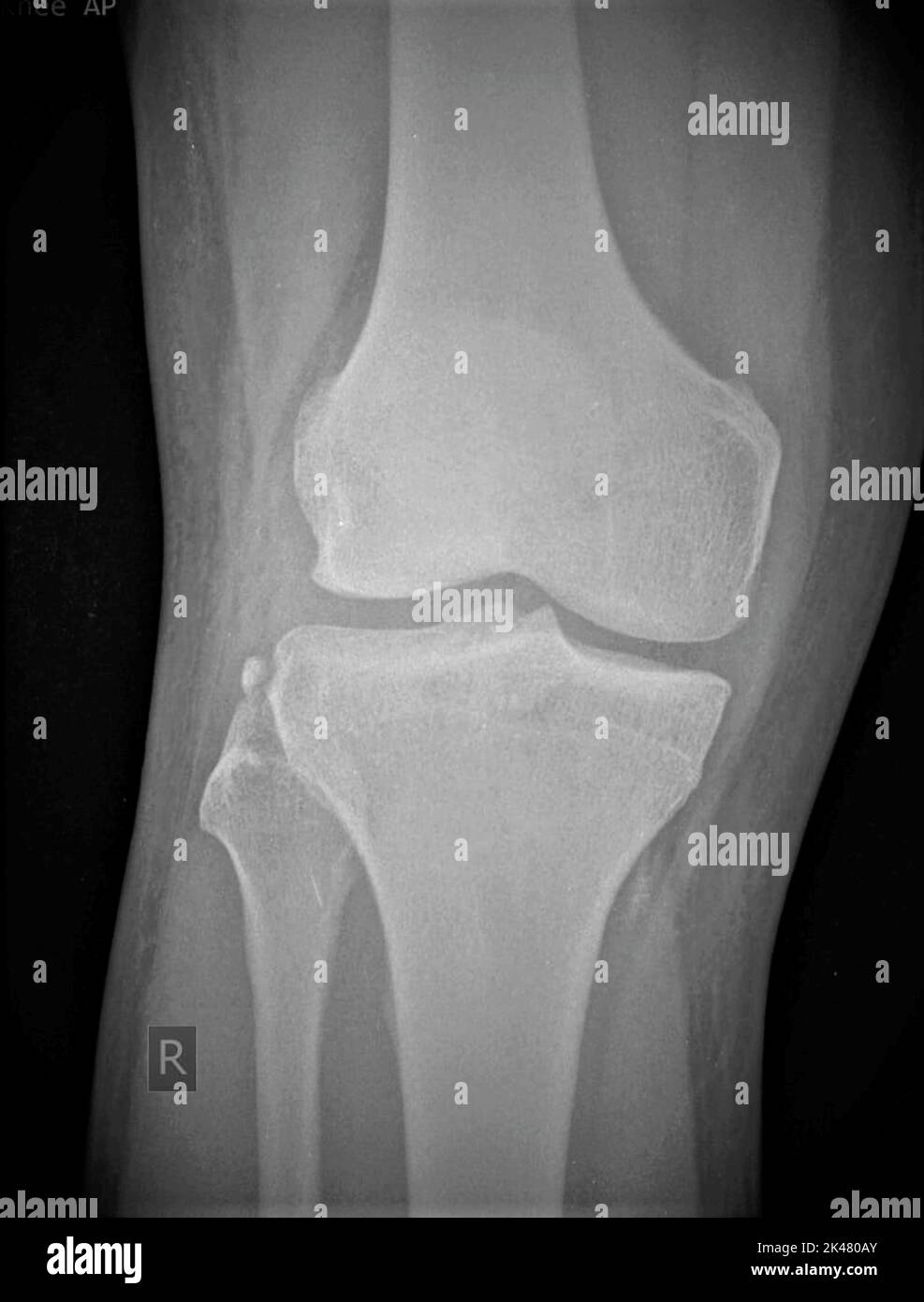 Frattura SEGOND, raggi X. Foto Stock
