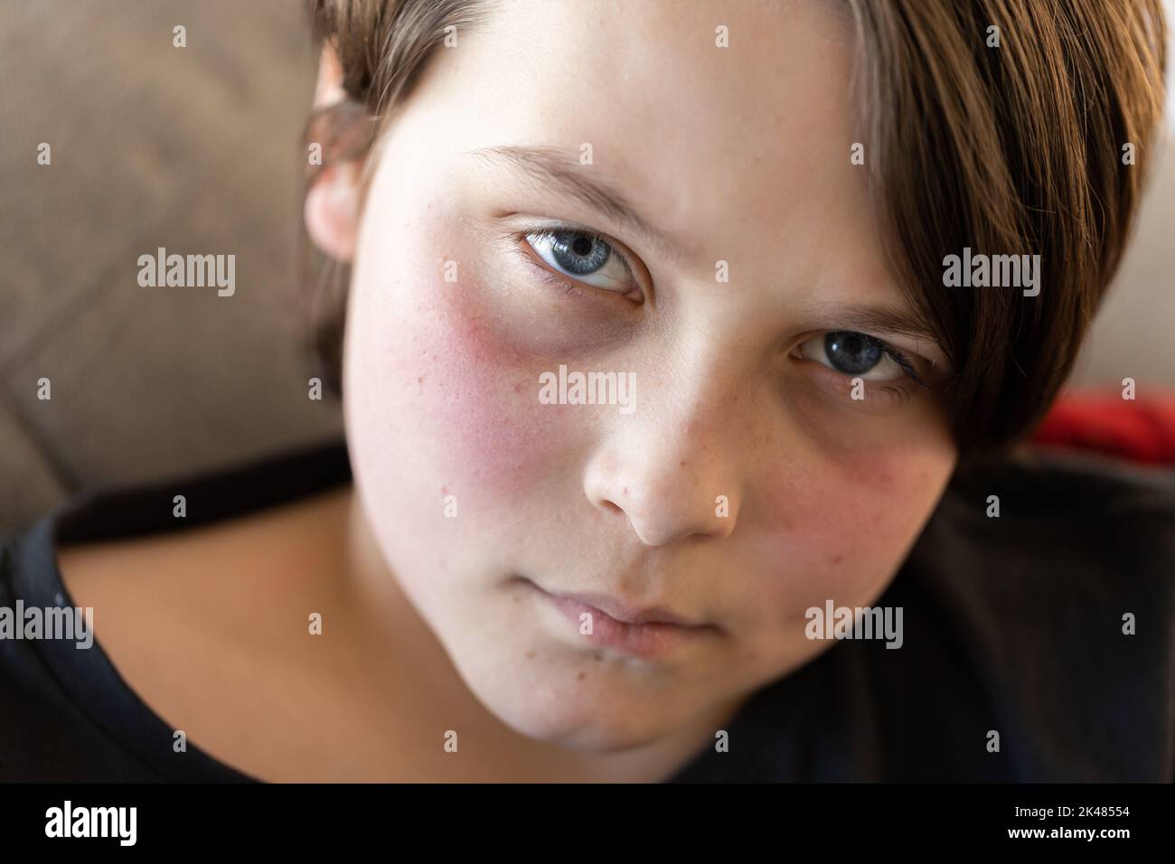 Un ragazzo malmeno sdraiato su un divano che guarda la telecamera, le guance sono rosse da una febbre e sembra miserabile Foto Stock