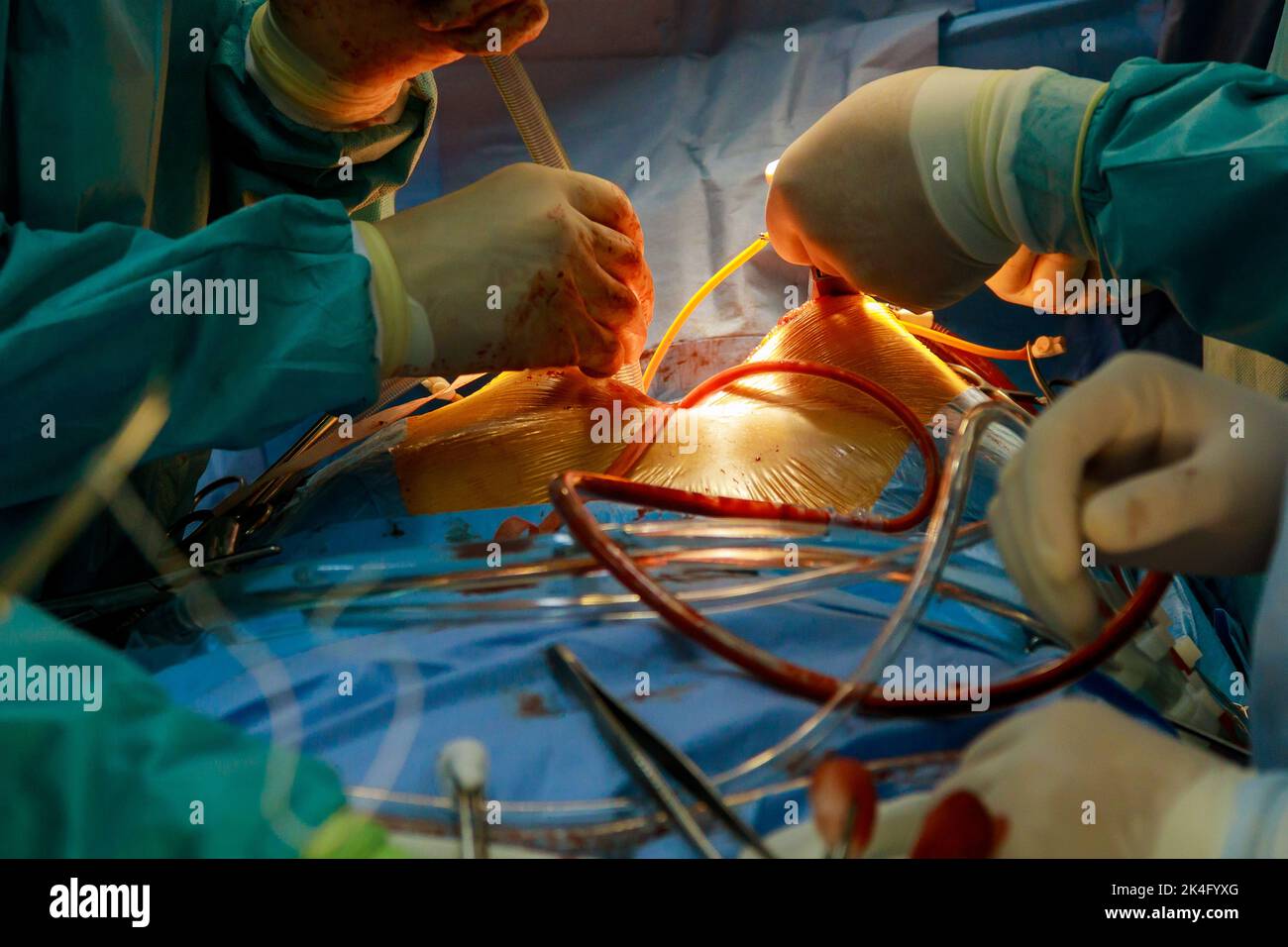 Come parte delle operazioni cardiache a causa di malattie coronariche che sono in corso di esecuzione nella sala operatoria di un ospedale, bypass coronarico arterie Foto Stock