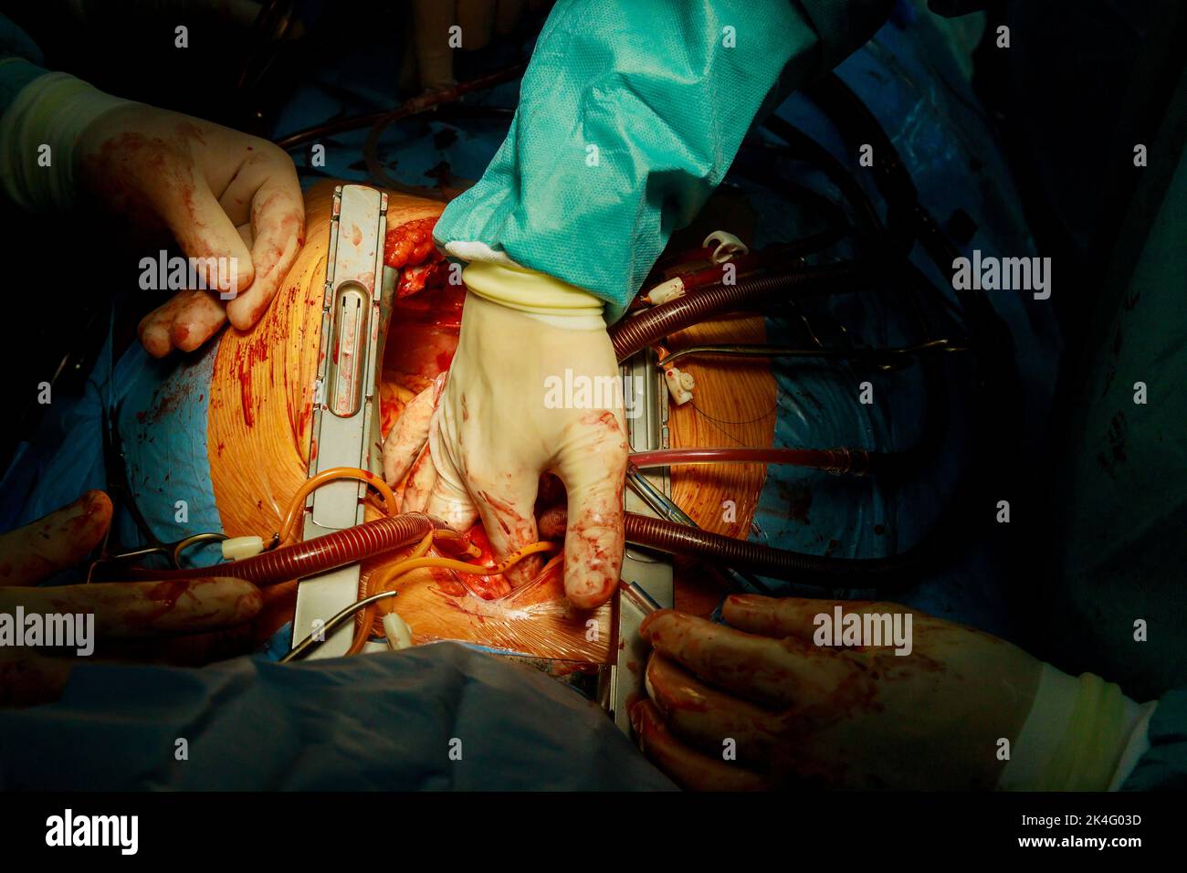 Una sala operatoria in un ospedale è dove gli innesti di bypass coronarico CABG sono eseguiti come parte delle operazioni cardiache a causa di malattia coronarica cuore Foto Stock