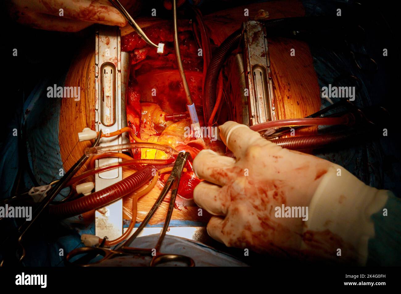 La sostituzione della valvola viene eseguita in sala operatoria quando una valvola malfunzionante nel cuore provoca un intervento chirurgico a cuore aperto Foto Stock