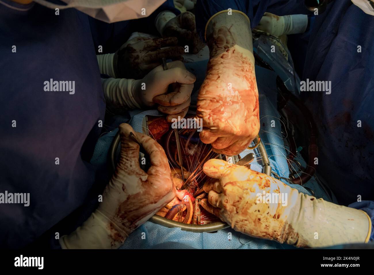 Un innesto di bypass dell'arteria coronaria CABG viene eseguito per operazioni cardiache a causa di malattie come la malattia cardiaca coronarica nella sala operatoria di A. Foto Stock