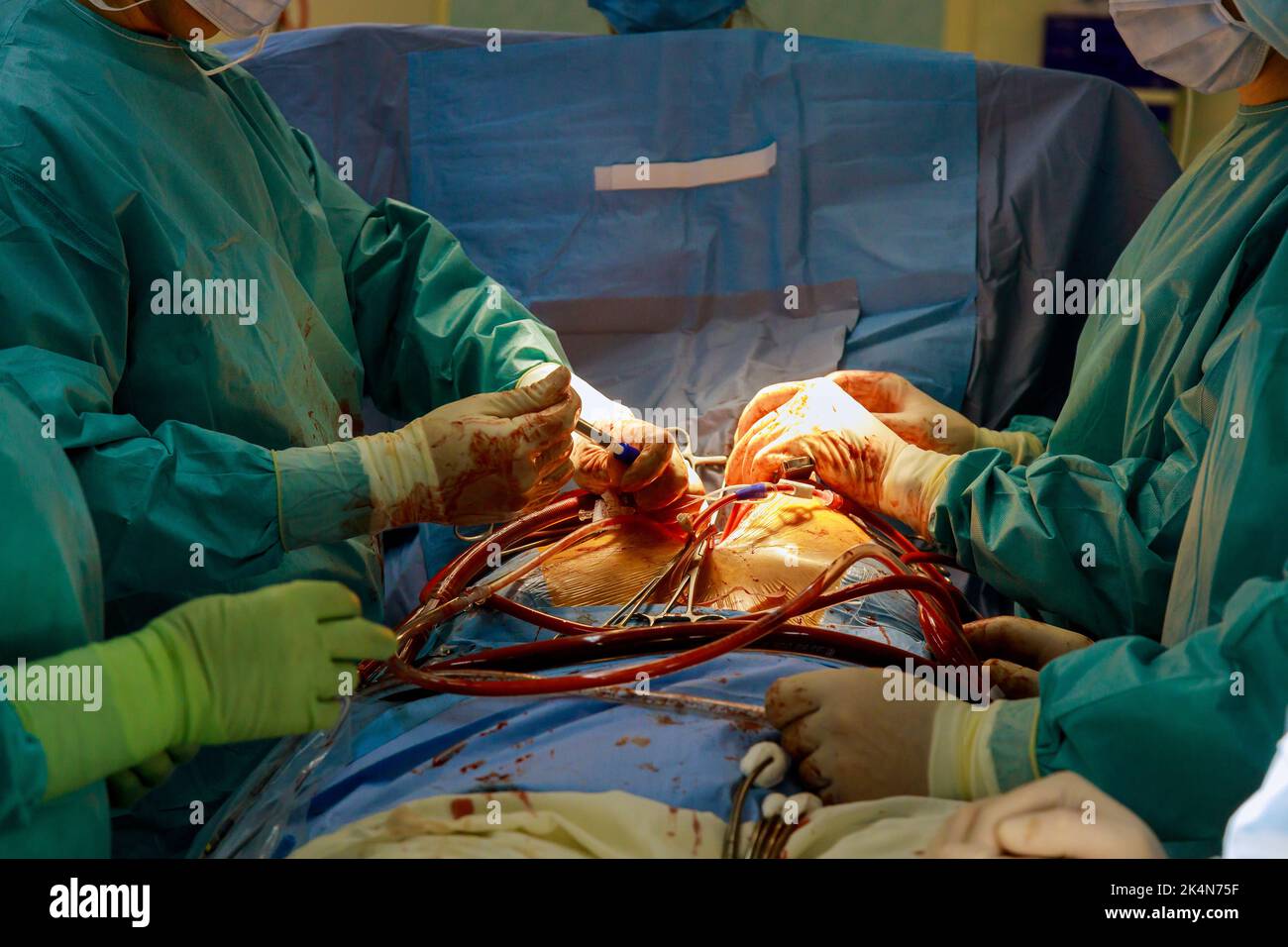 Un innesto di bypass coronarico CABG viene eseguito nella sala operatoria dell'ospedale per il trattamento di malattie cardiache a causa di malattie cardiache coronariche. Foto Stock