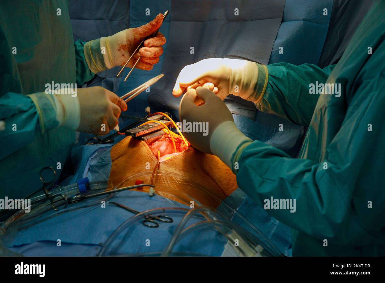 Intervento chirurgico a cuore aperto a causa di un malfunzionamento della valvola cardiaca, viene eseguita la sostituzione della valvola Foto Stock
