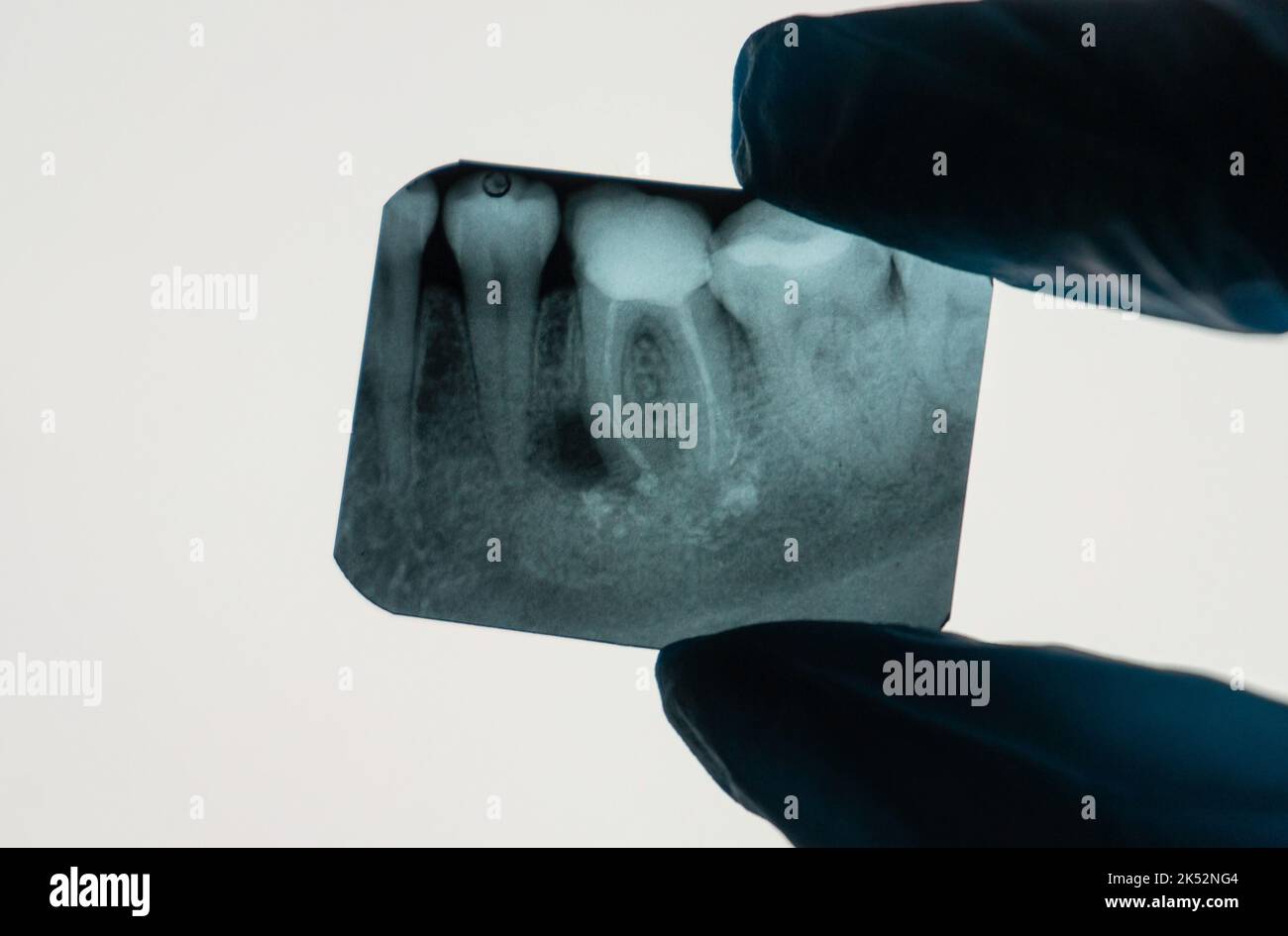Granuloma periapicale dentale vicino alla radice del dente su una radiografia tenuta da un dentista Foto Stock