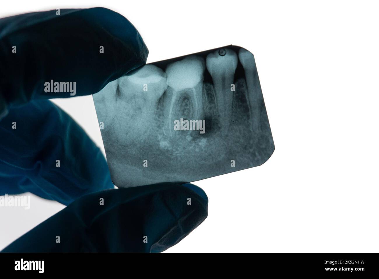 Granuloma dentale periapicale accanto alla radice del dente su una radiografia tenuta dal dentista Foto Stock