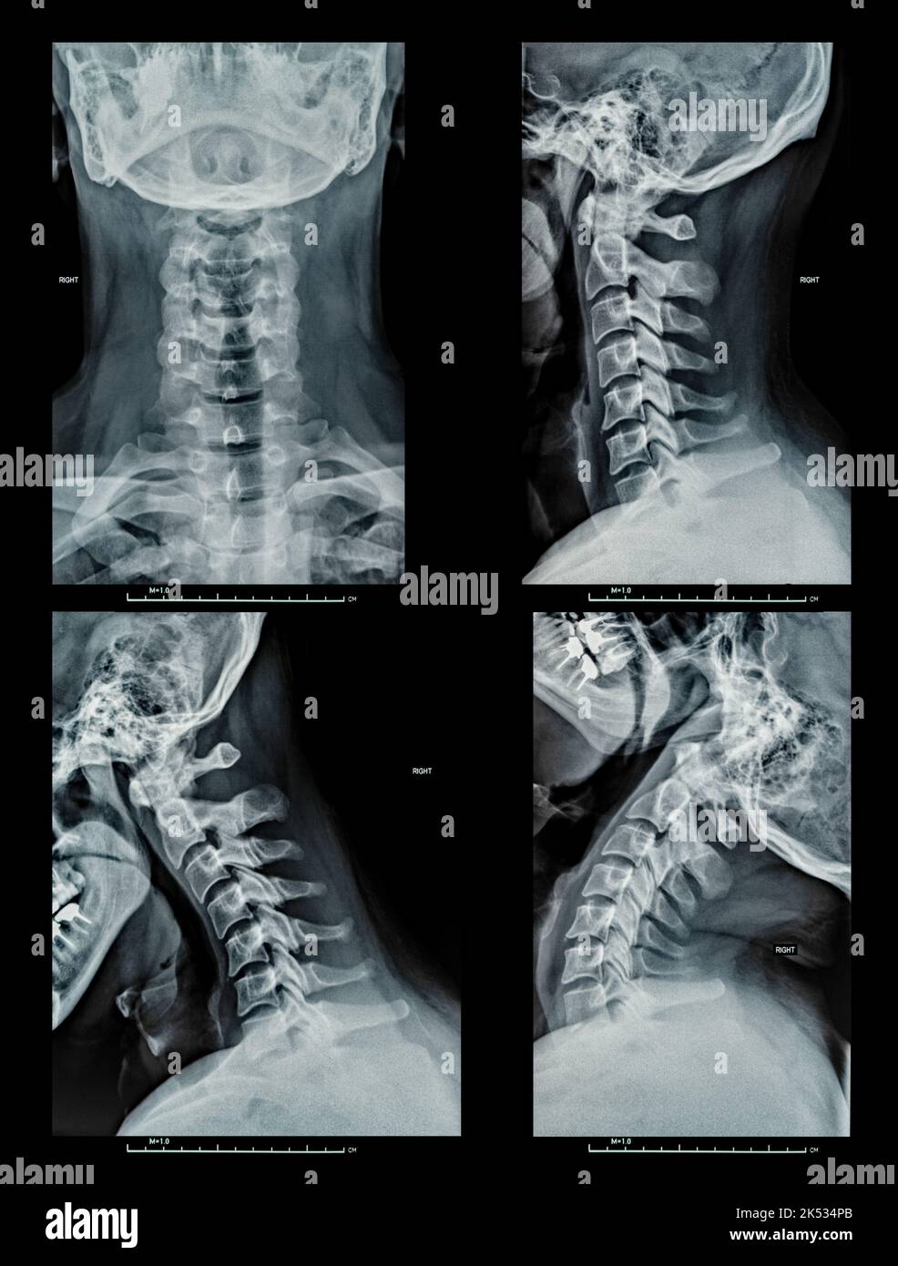 Il raggio del collo, i dischi e le ossa del collo, la testa, il cranio umano dettagliano tutte le forme Foto Stock