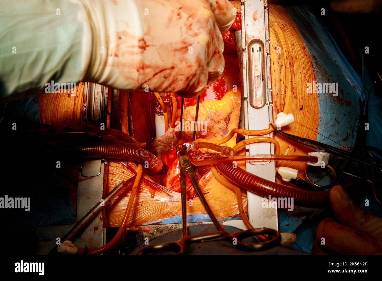 Il processo di bypass dell'arteria coronaria CABG per le operazioni cardiache dovute a cardiopatia coronarica avviene nella sala operatoria di un ospedale Foto Stock