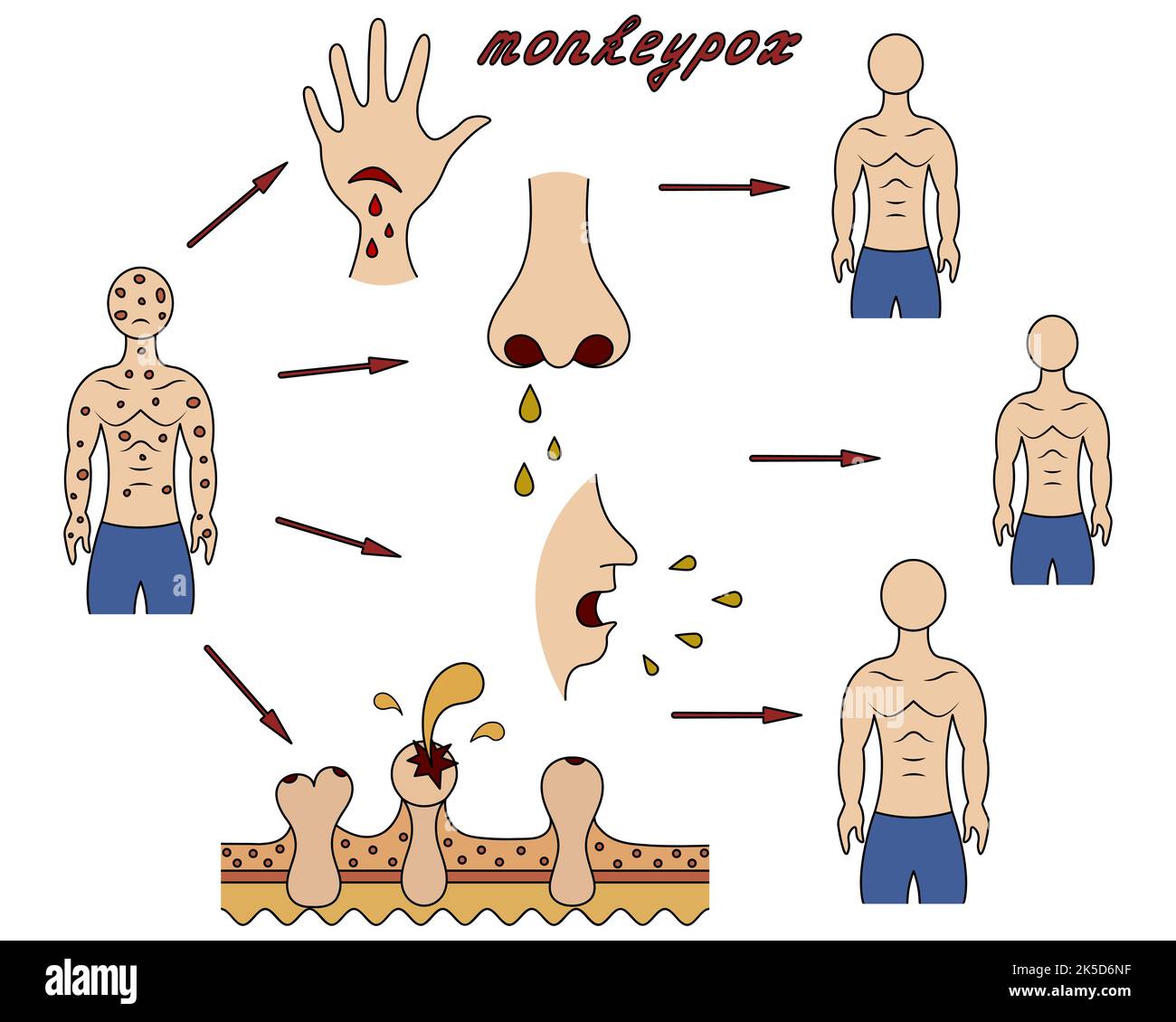 Metodi di infezione umana con monkeypox. Diagramma della trasmissione del vaiolo da uomo a uomo. Illustrazione del vettore dei colori. Illustrazione Vettoriale