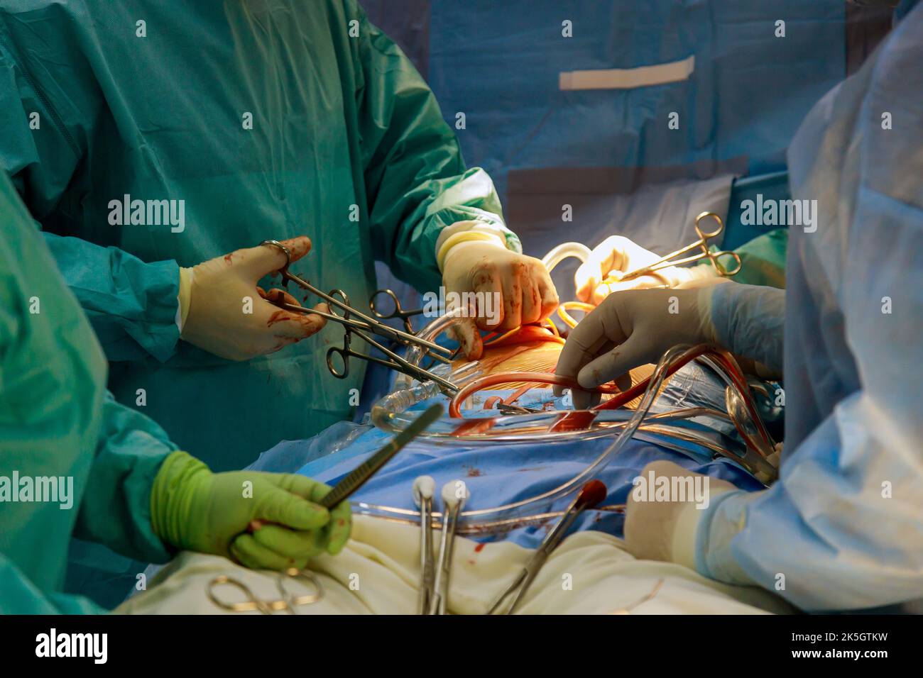 Procedura di bypass coronarico innesto CABG per l'operazione un cuore a causa di malattia coronarica in una sala operatoria in ospedale Foto Stock