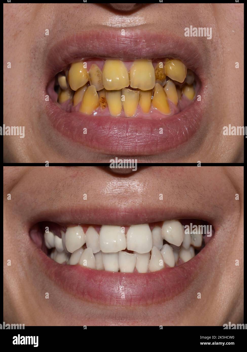 Prima e dopo il trattamento di incrostazione e lucidatura per macchie di tabacco su denti affollati di giovane asiatico. Foto Stock