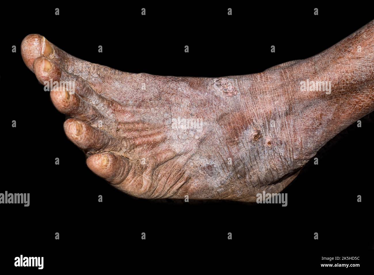 Pelle secca, incrostata e squamosa ai piedi dell'uomo asiatico, birmano. Dermatite piede. Foto Stock