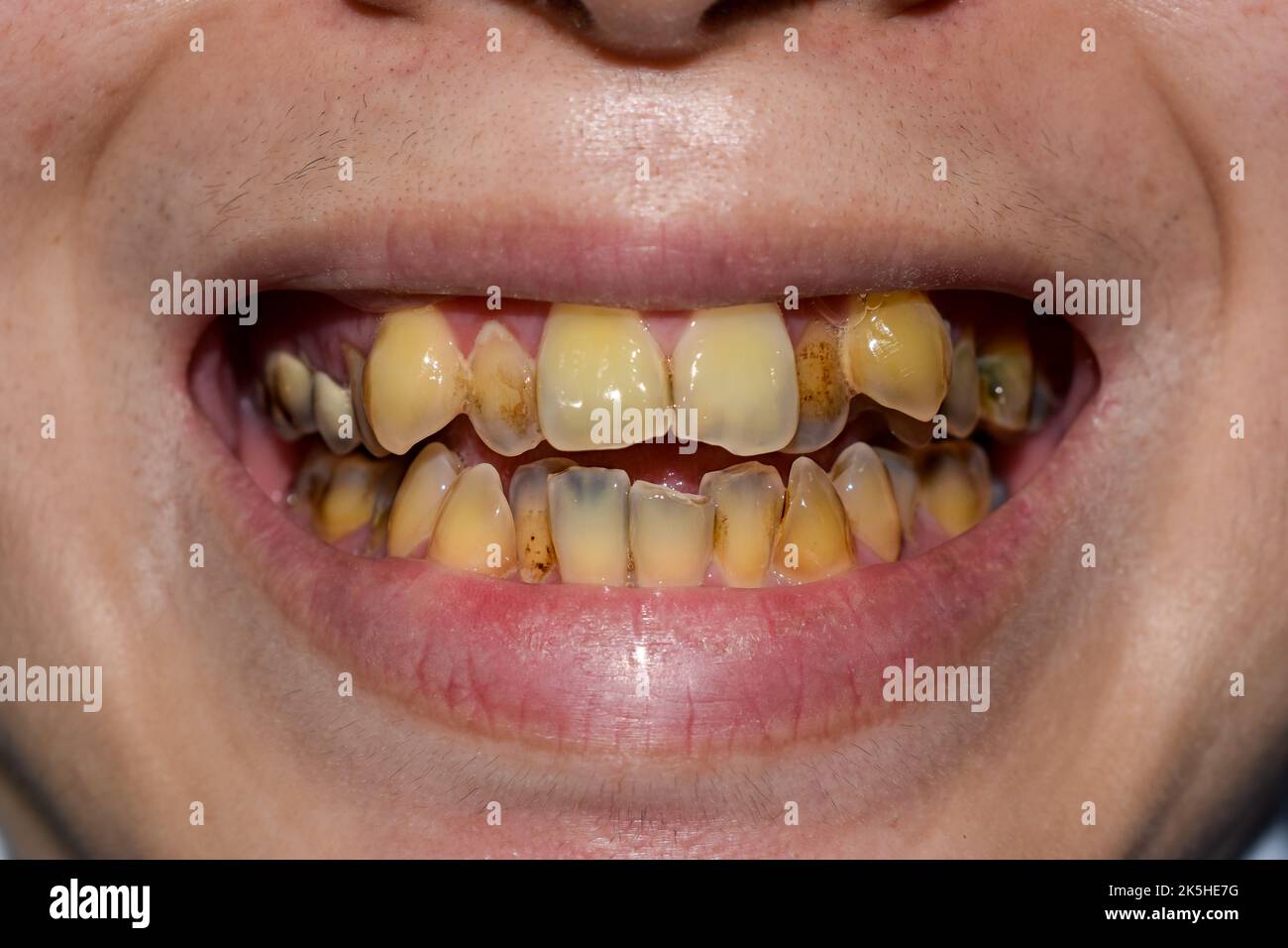 Denti affollati con macchie di tabacco di colore giallo. Scarsa igiene orale. Foto Stock