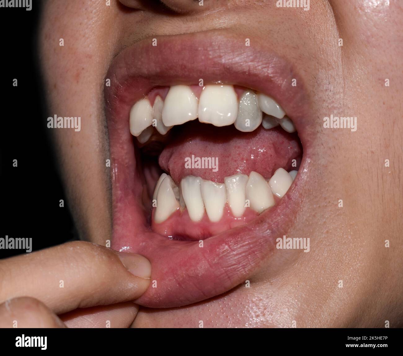 Denti bianchi sovrapposti o sovrapposti dell'uomo asiatico. Chiamato anche denti affollati. Foto Stock