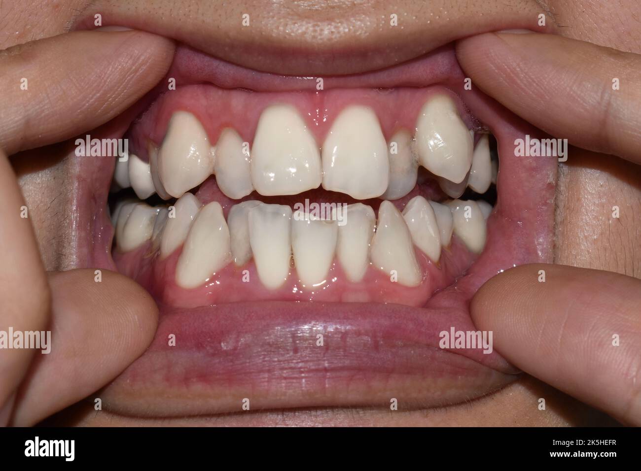 Denti bianchi sovrapposti o sovrapposti dell'uomo asiatico. Chiamato anche denti affollati. Foto Stock