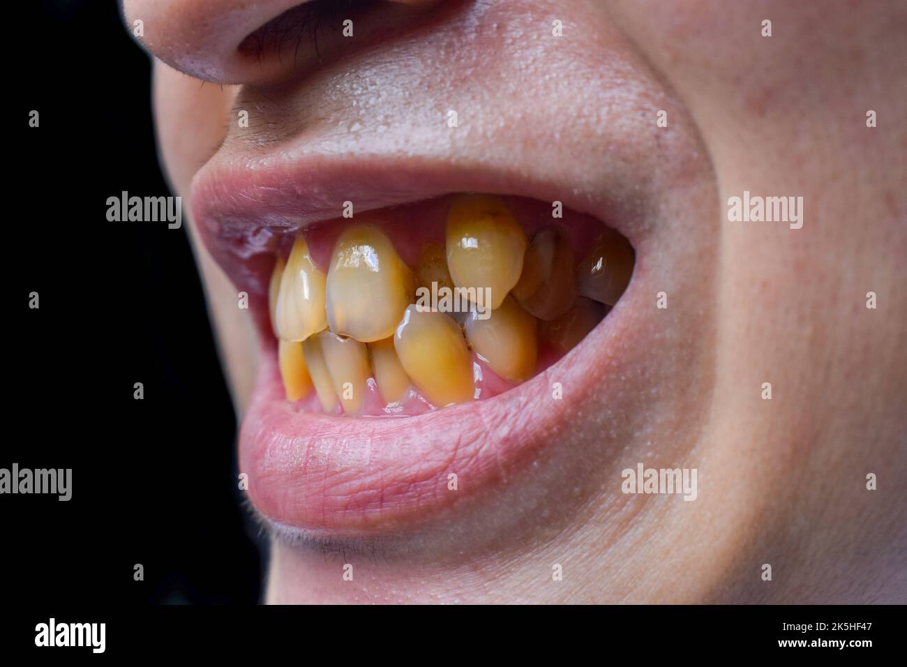 Macchia i denti immagini e fotografie stock ad alta risoluzione