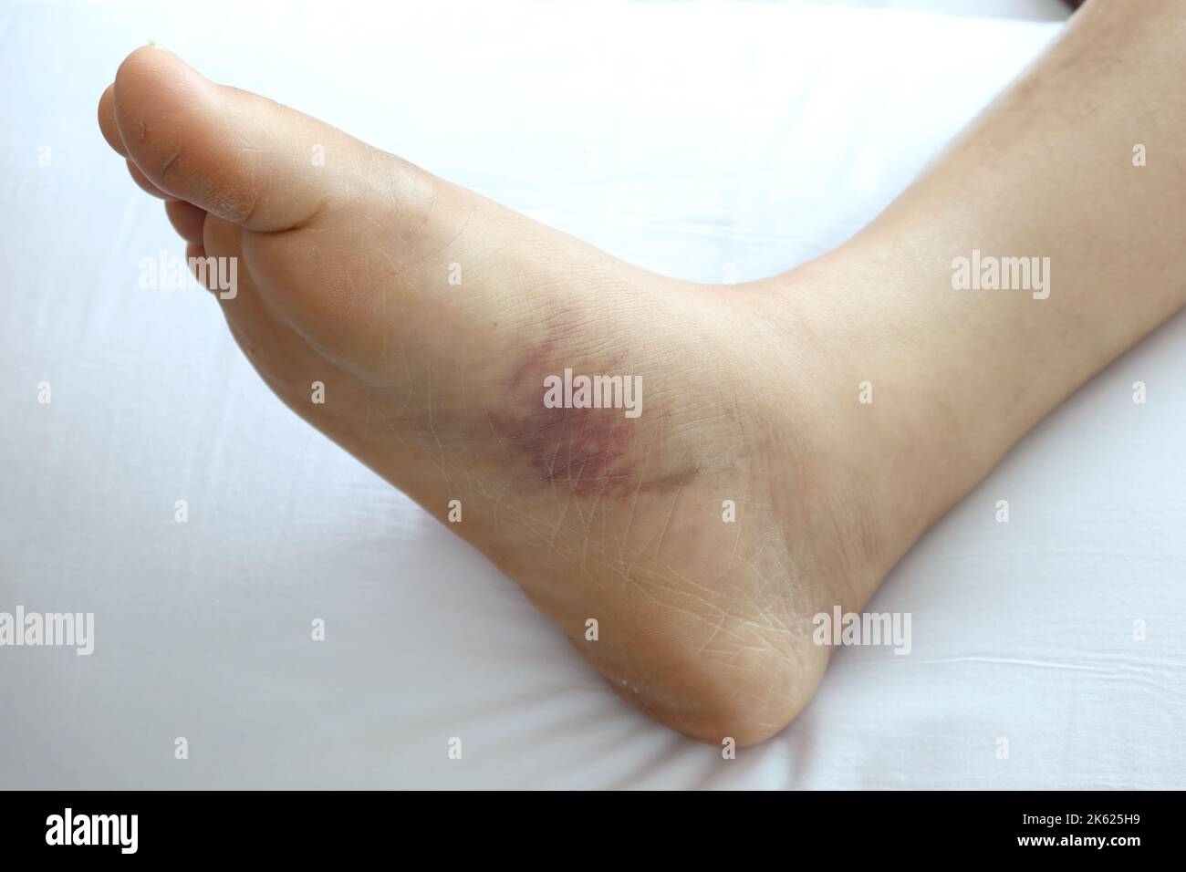 primo piano dei piedi delle donne con gonfiore Foto Stock