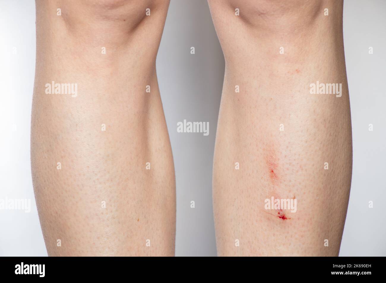 Gamba femmina con graffio dopo una caduta su sfondo bianco, una ferita sulla gamba con sangue Foto Stock