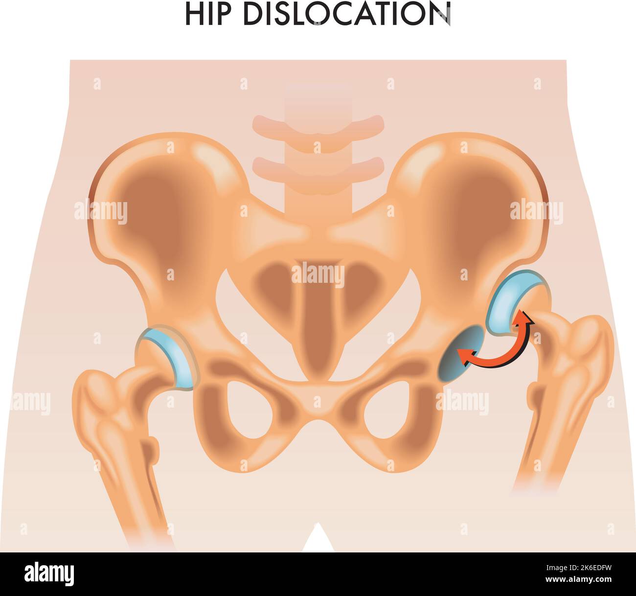 Illustrazione medica della dislocazione dell'anca. Illustrazione Vettoriale