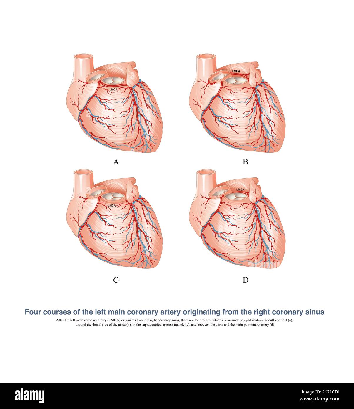 L'arteria coronaria sinistra anormale è originata dal seno coronarico destro, che è una delle cause di morte improvvisa. Foto Stock