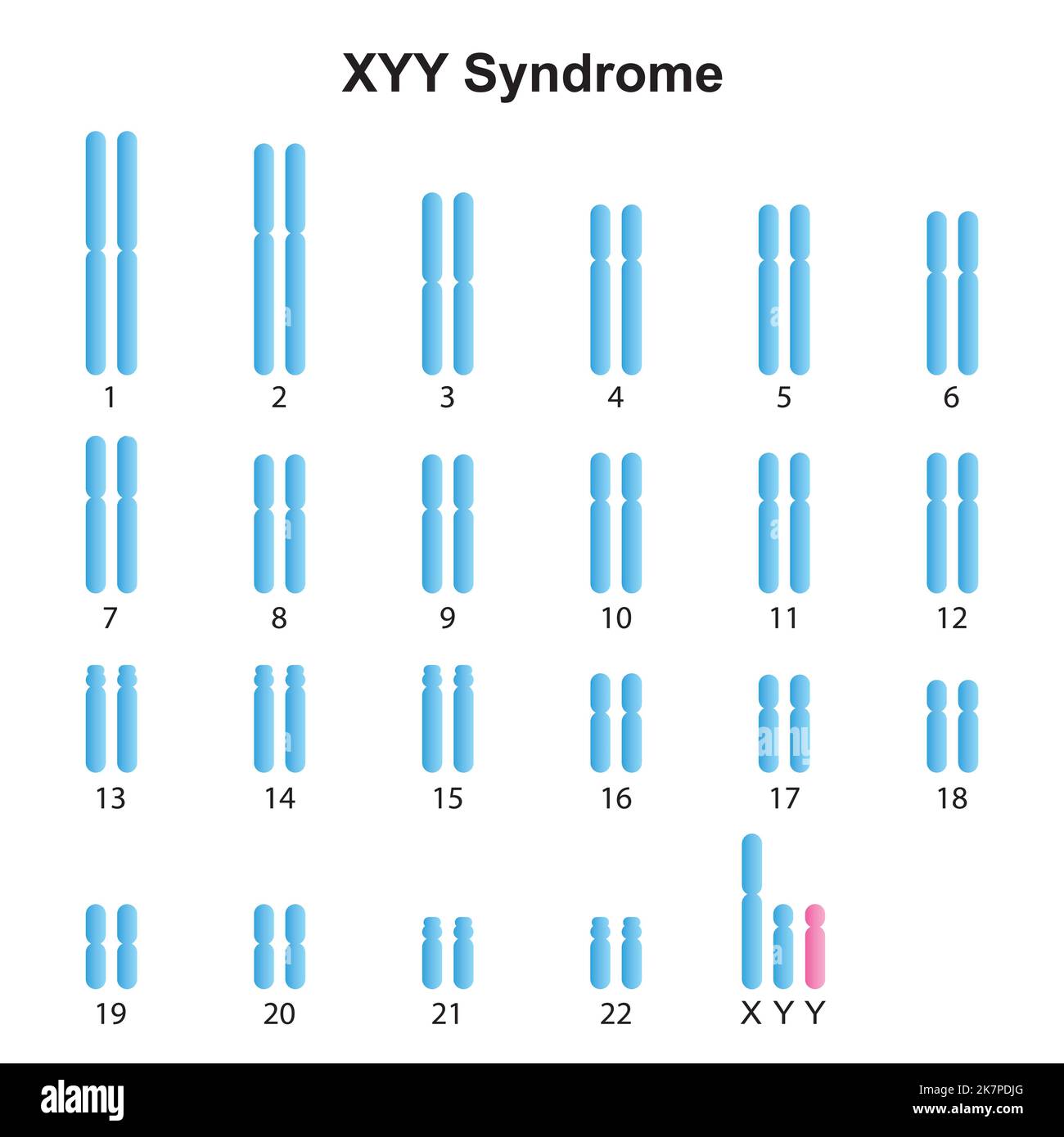 Progettazione scientifica della sindrome di Jacobs (XYY) Karyotype. Simboli colorati. Illustrazione vettoriale. Illustrazione Vettoriale