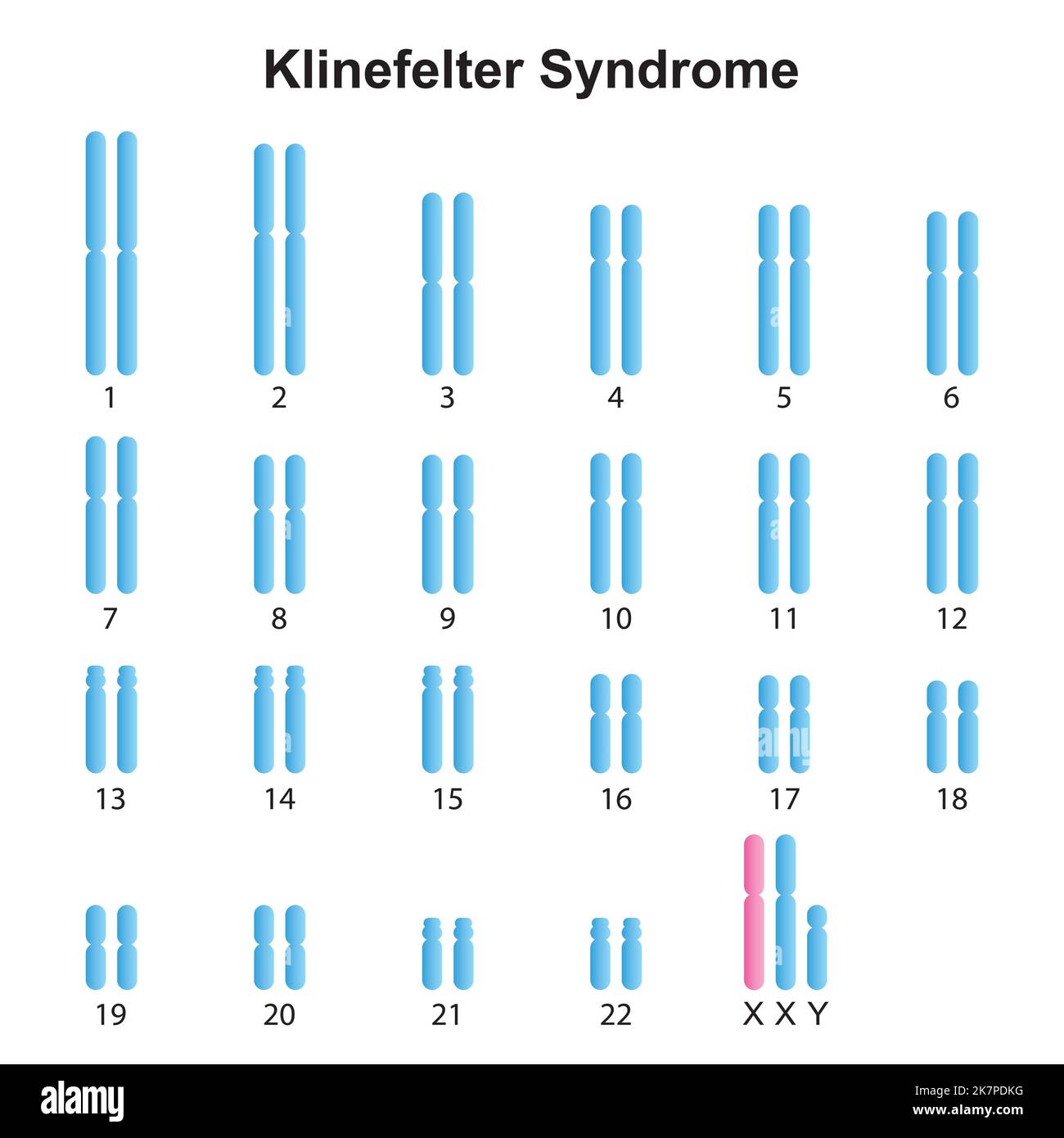Progettazione scientifica della sindrome di Klinefelter (XXY) Karyotype. Simboli colorati. Illustrazione vettoriale. Illustrazione Vettoriale