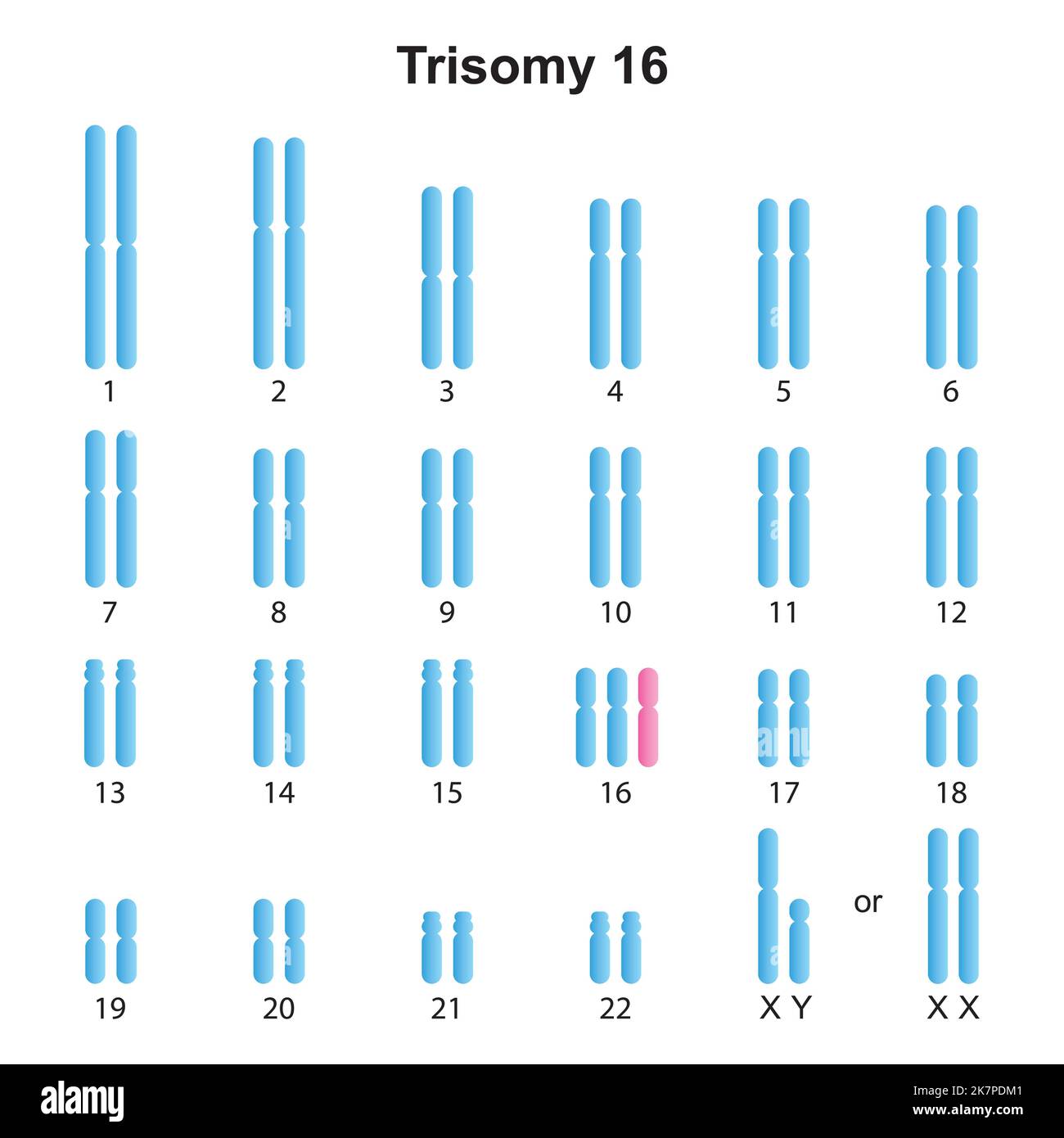 Progettazione scientifica della Trisomia Mosaica 18 Karyotype. Simboli colorati. Illustrazione vettoriale. Illustrazione Vettoriale