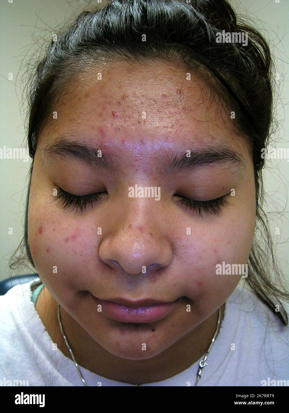 Acne sulla faccia della ragazza. L'acne è un nome generale dato ad un  disordine della pelle in cui le ghiandole sebacee diventano infiammate. La  forma più comune, vulgaris dell'acne, comincia nell'adolescenza ed