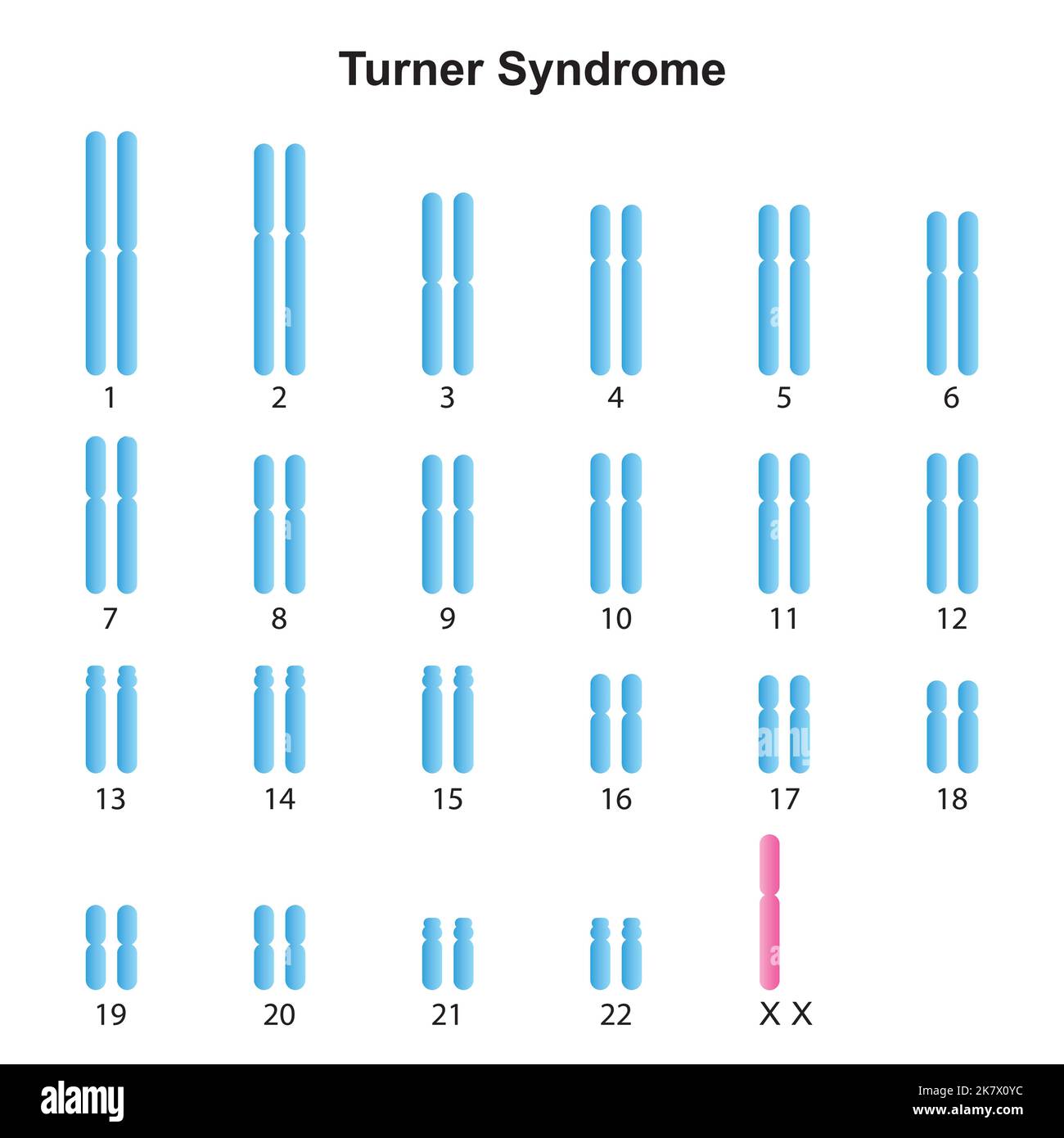 Progettazione scientifica della sindrome di Turner (monosomia X) Karyotype. Simboli colorati. Illustrazione vettoriale. Illustrazione Vettoriale