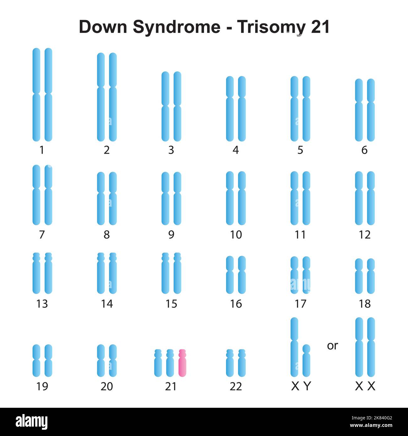 Progettazione scientifica della sindrome di Down (Trisomia 21) Karyotype. Simboli colorati. Illustrazione vettoriale. Illustrazione Vettoriale