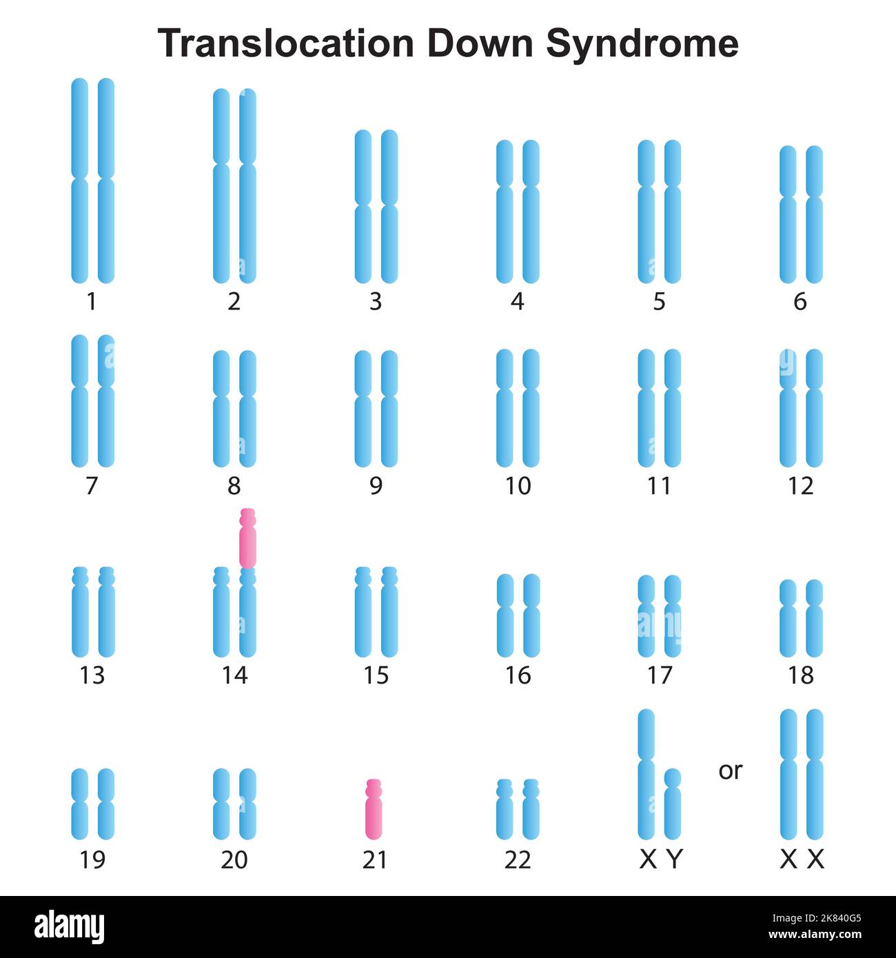 Progettazione scientifica della traslocazione Robertsonian Down Syndrome Karyotype. Simboli colorati. Illustrazione vettoriale. Illustrazione Vettoriale