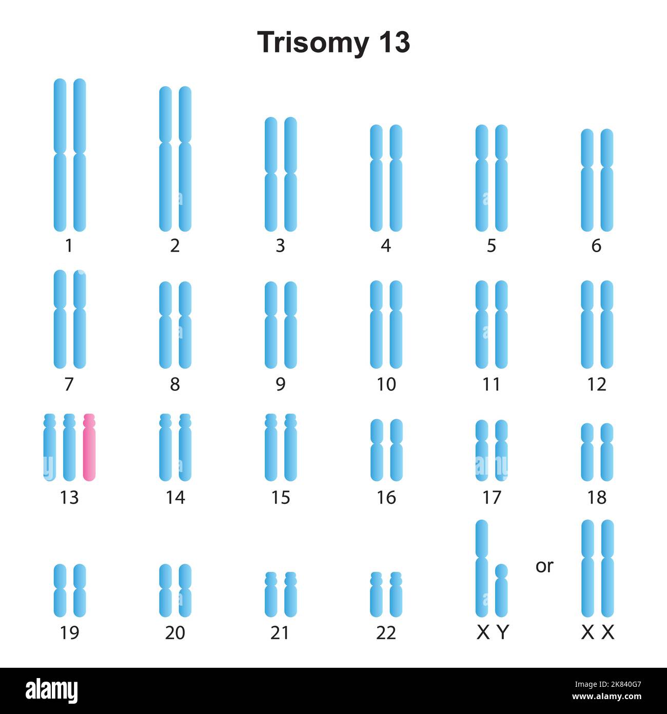 Progettazione scientifica della sindrome di Patau (Trisomia 13) Karyotype. Simboli colorati. Illustrazione vettoriale. Illustrazione Vettoriale