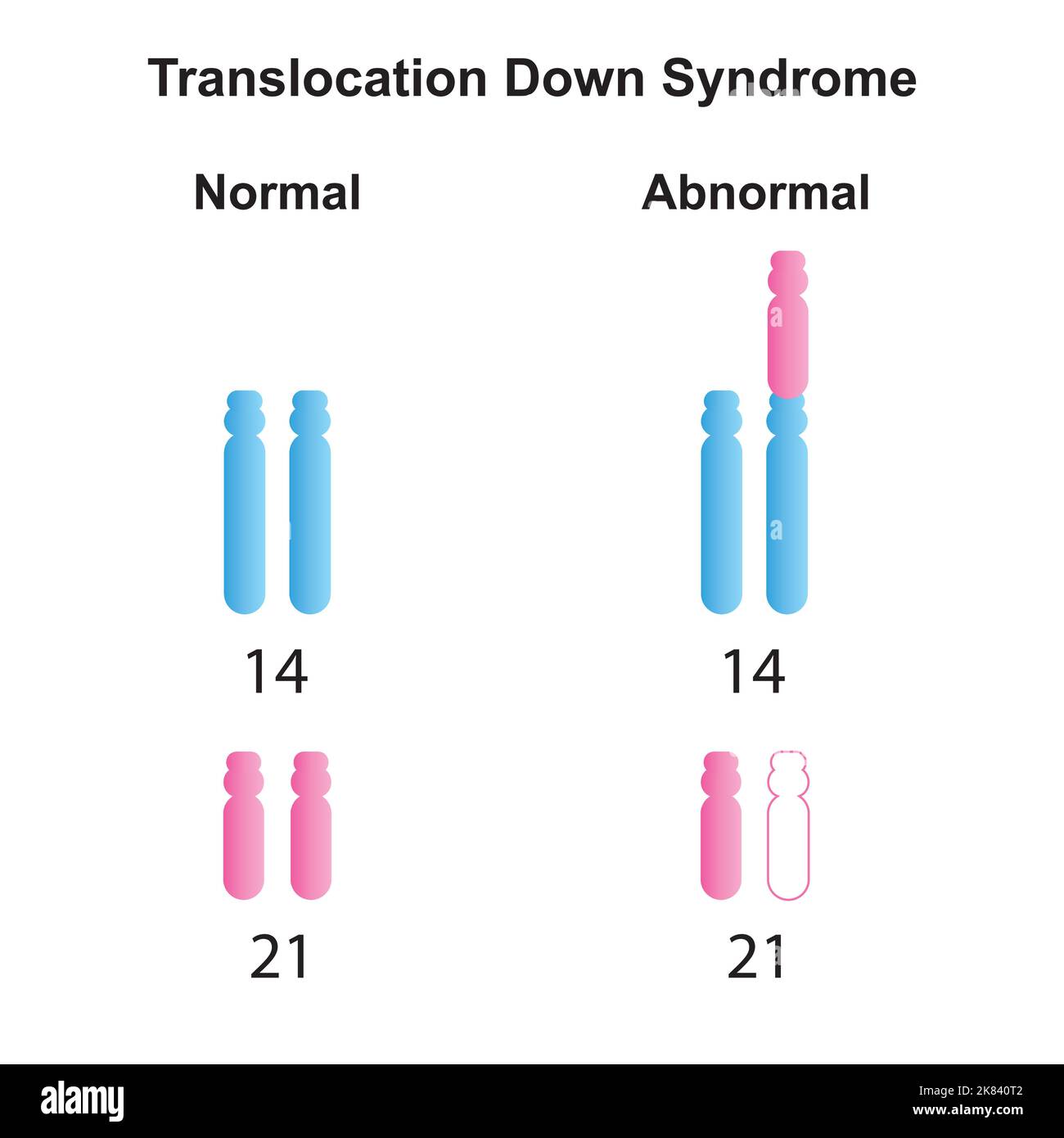 Progettazione scientifica della sindrome di traslocazione di Robertsonian giù. Simboli colorati. Illustrazione vettoriale. Illustrazione Vettoriale