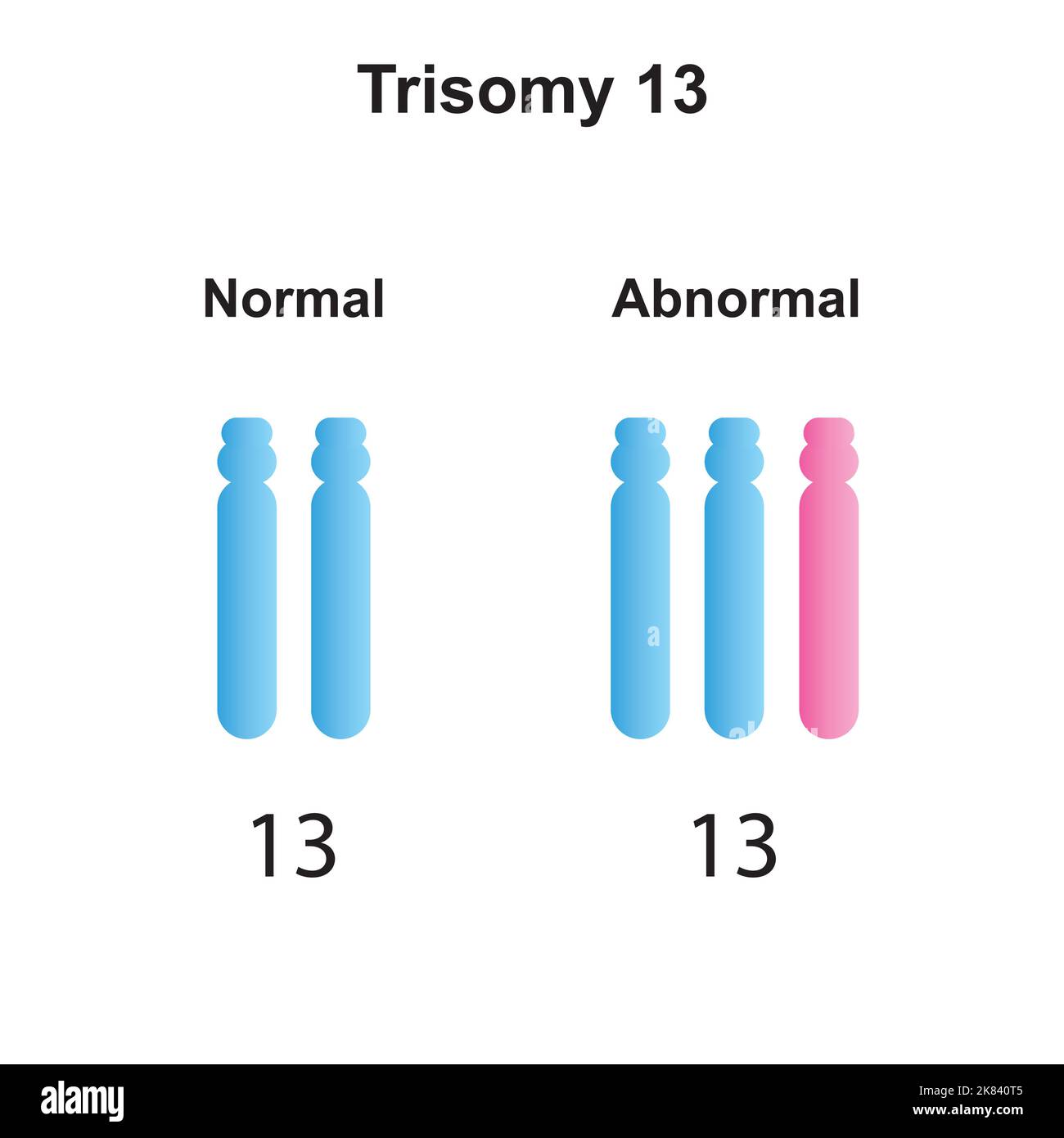 Progettazione scientifica della sindrome di Patau (Trisomia 13). Simboli colorati. Illustrazione vettoriale. Illustrazione Vettoriale