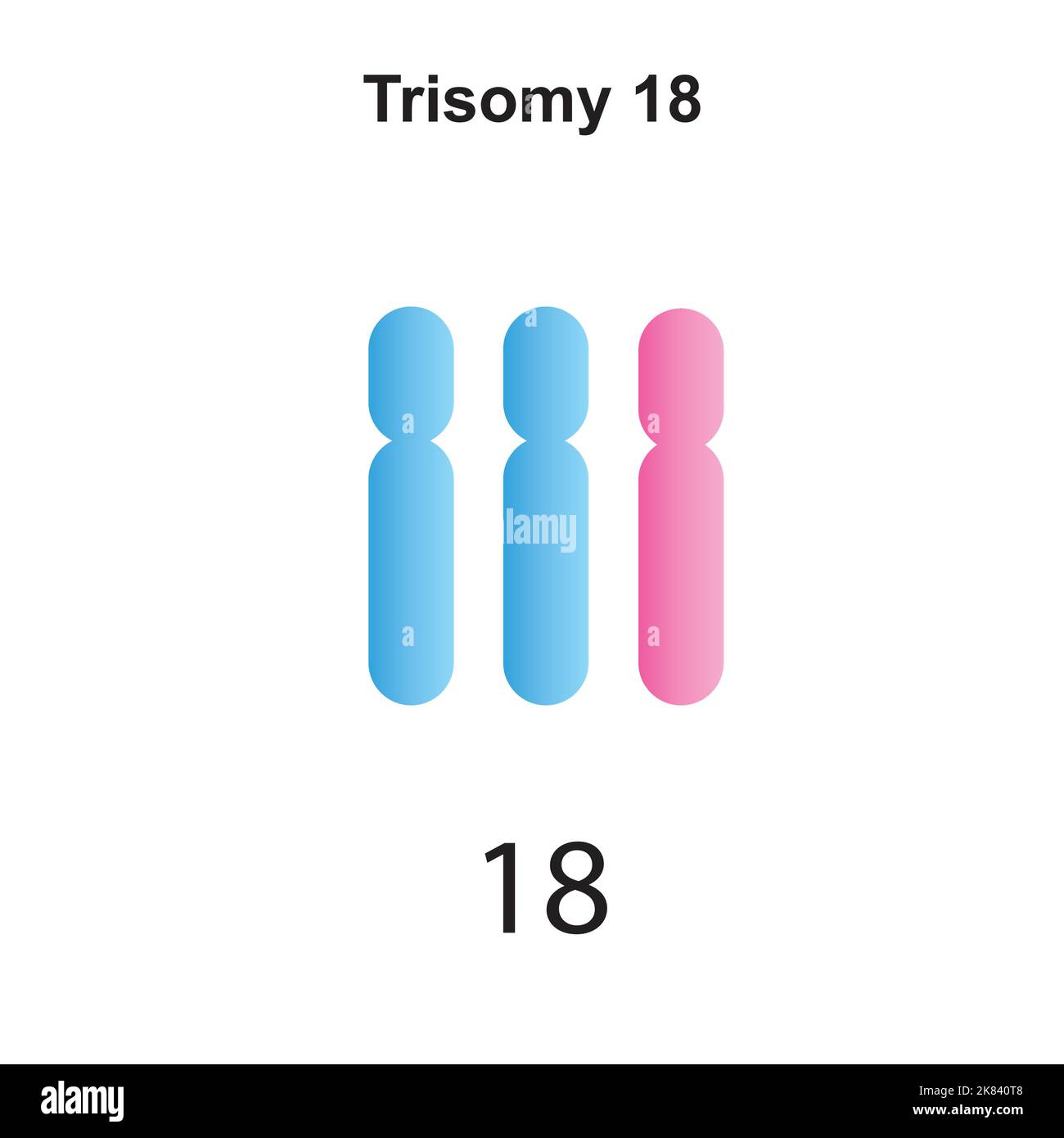 Progettazione scientifica della sindrome di Edwards (Trisomy 18). Simboli colorati. Illustrazione vettoriale. Illustrazione Vettoriale