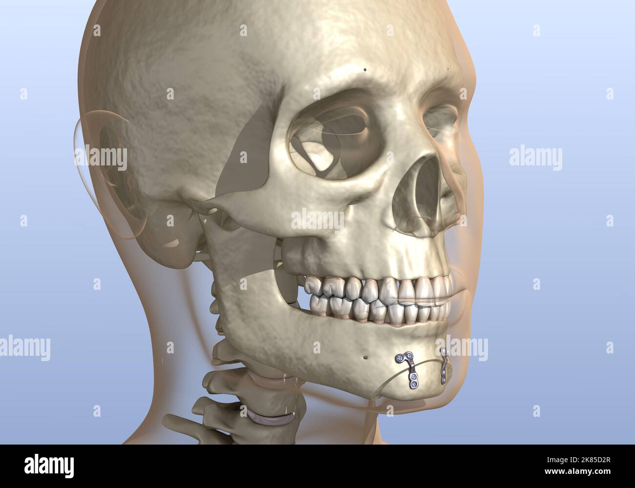 Chirurgia di riduzione del mento (genioplastica ossea). Illustrazione dentale 3D accurata dal punto di vista medico. Foto Stock