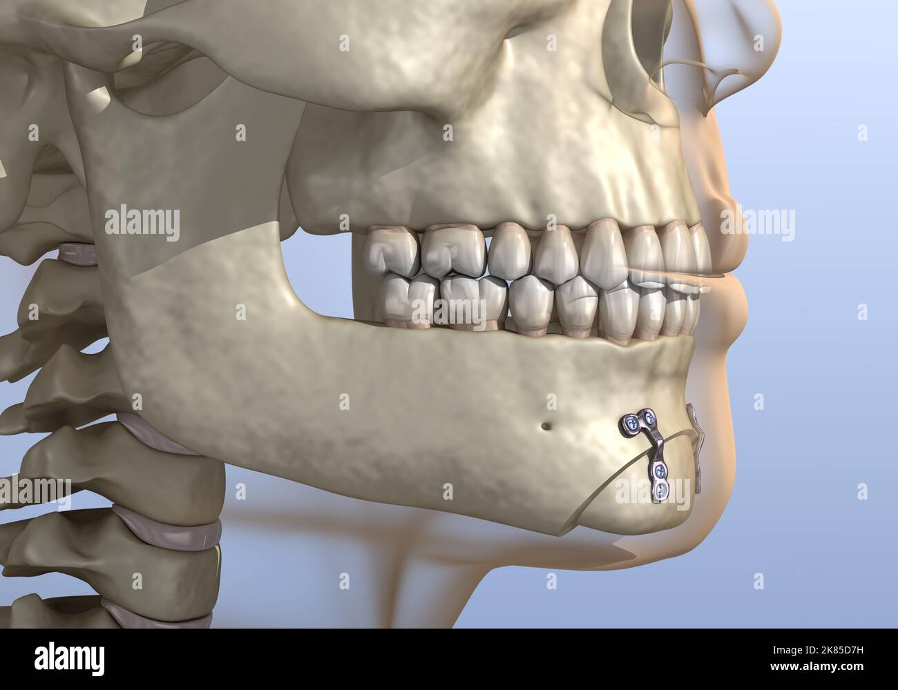 Chirurgia di riduzione del mento (genioplastica ossea). Illustrazione dentale 3D accurata dal punto di vista medico. Foto Stock