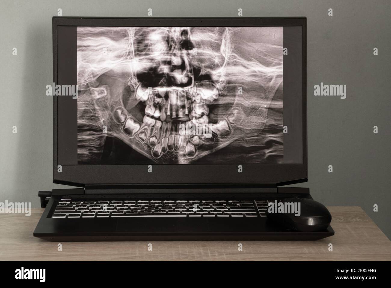 Raggi X panoramici dei denti dei bambini di due mascelle, ortopantomogramma dei denti dei bambini sugli schermi dei computer portatili sul tavolo Foto Stock