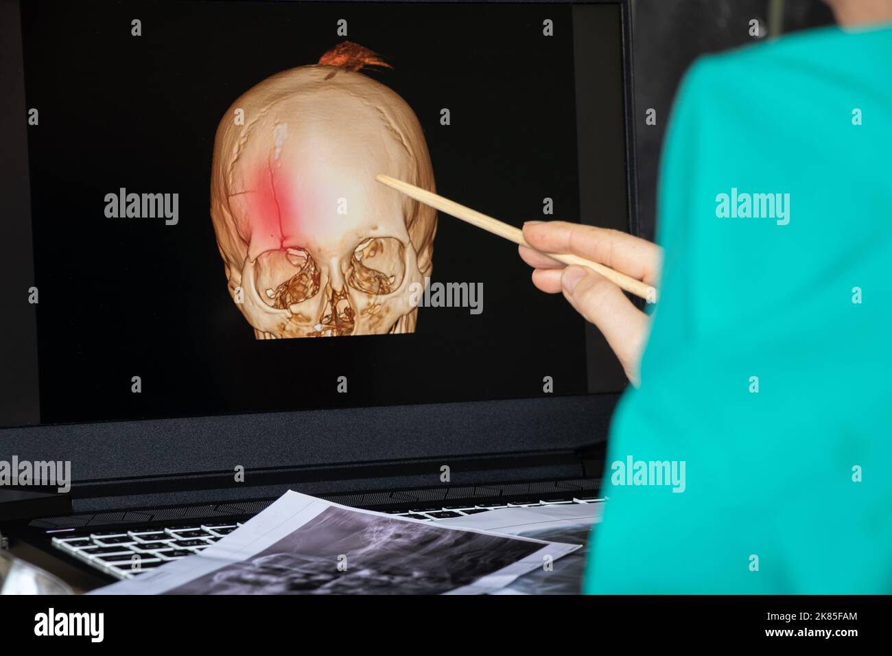 3D tomografia computerizzata del cervello con una frattura della parte frontale del cranio dopo ferita sugli schermi del laptop sul tavolo sugli schermi del laptop a. Foto Stock