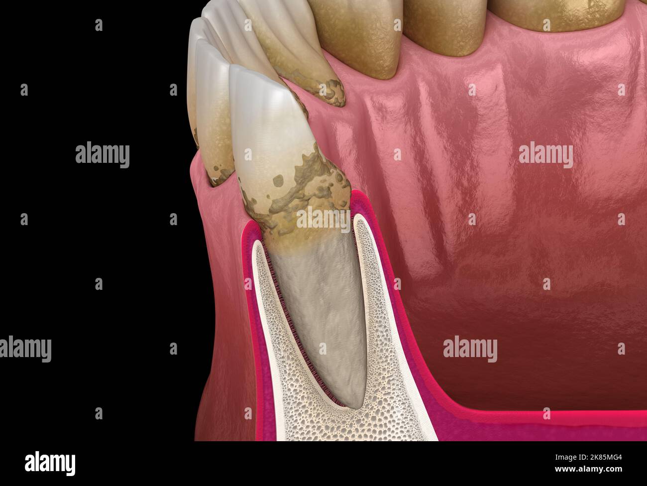 Periodontite fase 1, recessione gengivale, tartaro. Illustrazione 3D accurata dal punto di vista medico Foto Stock