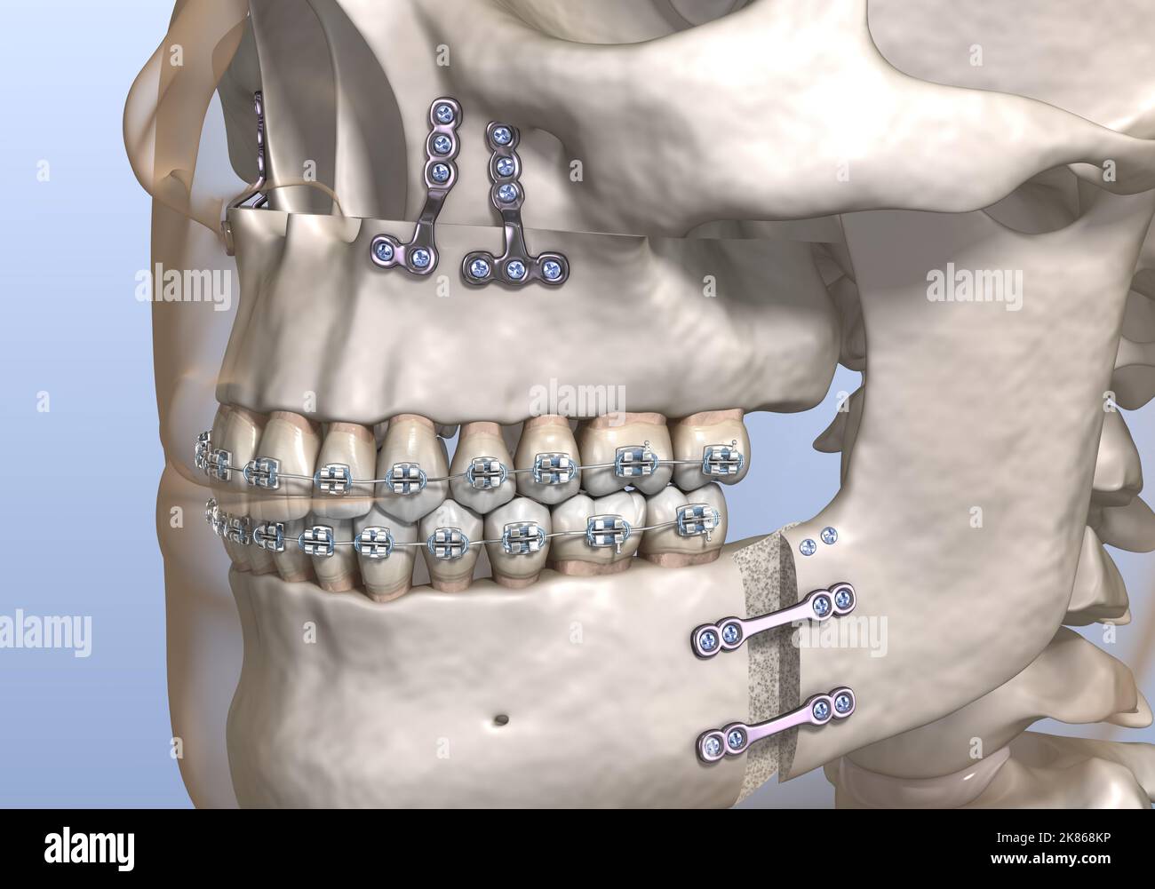 Chirurgia di avanzamento Maxillomandibolare. Illustrazione dentale 3D accurata dal punto di vista medico. Foto Stock