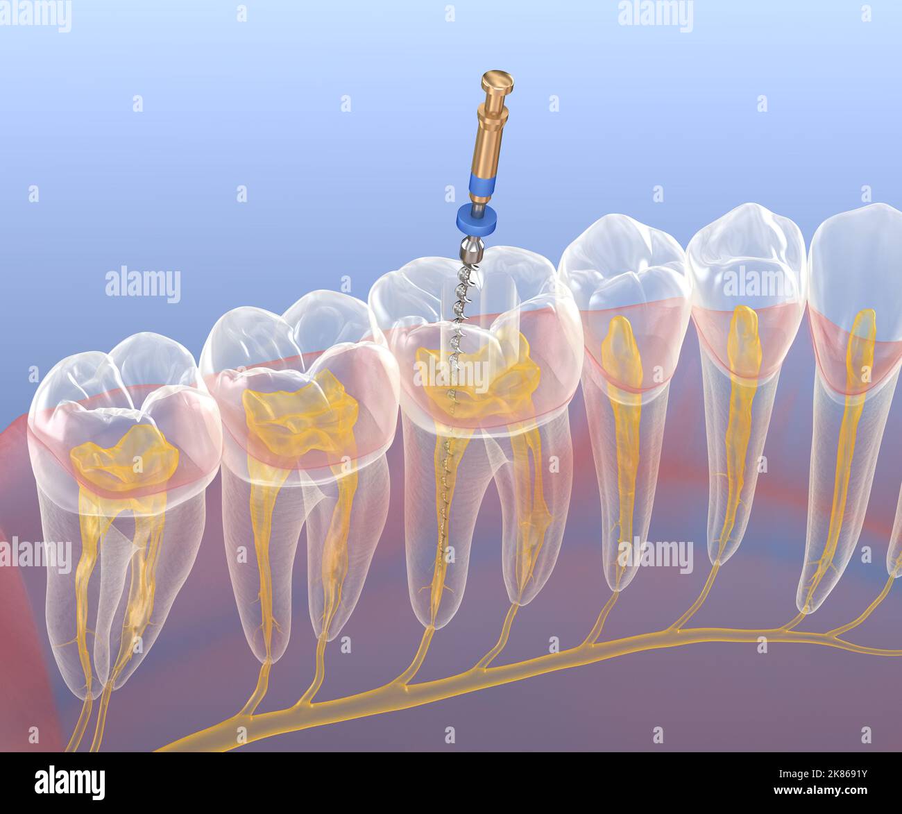 Processo di trattamento endodontico del canale radicolare. Illustrazione del dente 3D accurata dal punto di vista medico. Foto Stock